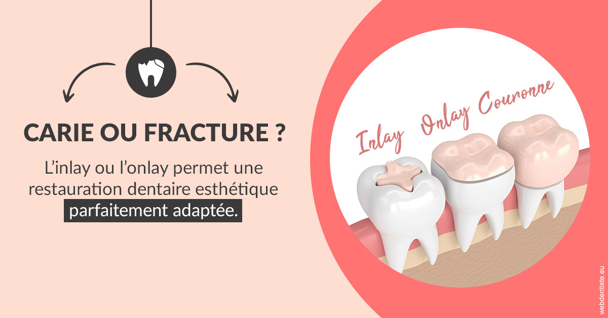 https://www.orthodontie-bruxelles-gilkens.be/T2 2023 - Carie ou fracture 2