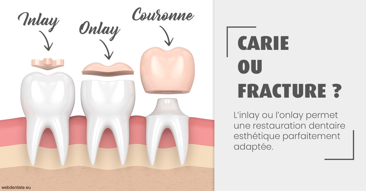 https://www.orthodontie-bruxelles-gilkens.be/T2 2023 - Carie ou fracture 1