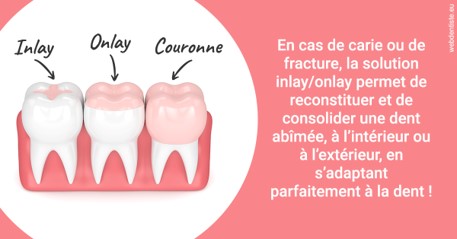 https://www.orthodontie-bruxelles-gilkens.be/L'INLAY ou l'ONLAY 2