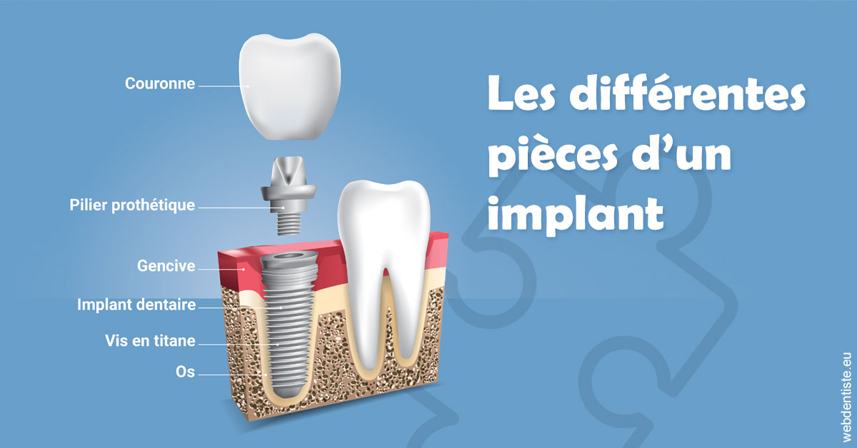 https://www.orthodontie-bruxelles-gilkens.be/Les différentes pièces d’un implant 1